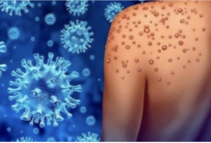 Déjà 4 cas de variole de singe à La Réunion (photo DROM-COM)