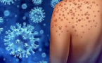 Variole B (Mpox) à La Réunion: deux nouveaux cas à La Réunion, déjà quatre cas!
