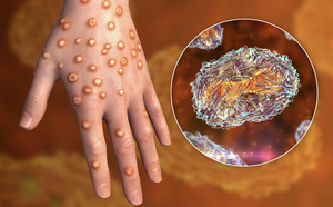 Variole du singe à La Réunion: encore deux nouveaux cas !