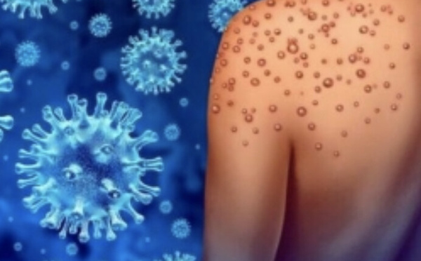 Variole B (Mpox) à La Réunion: deux nouveaux cas à La Réunion, déjà quatre cas!