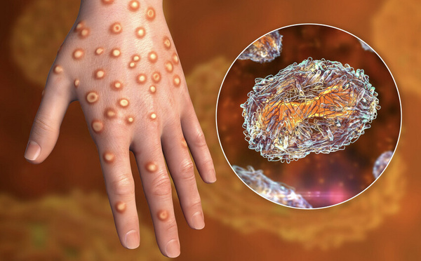 Variole du singe à La Réunion: encore deux nouveaux cas !